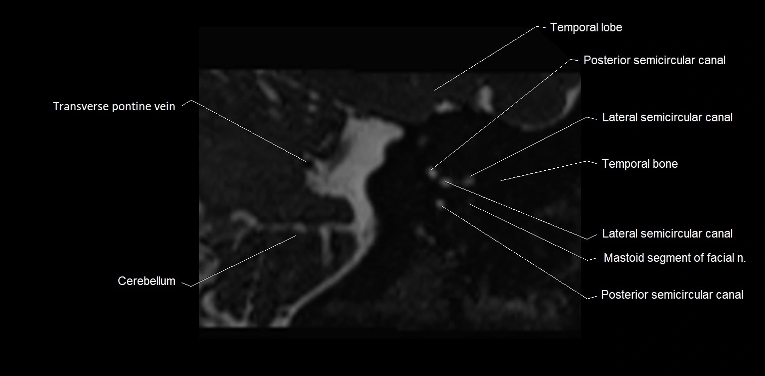 MRI Internal auditory meatus (IAM) coronal cross sectional labelled anatomy image 27.webp